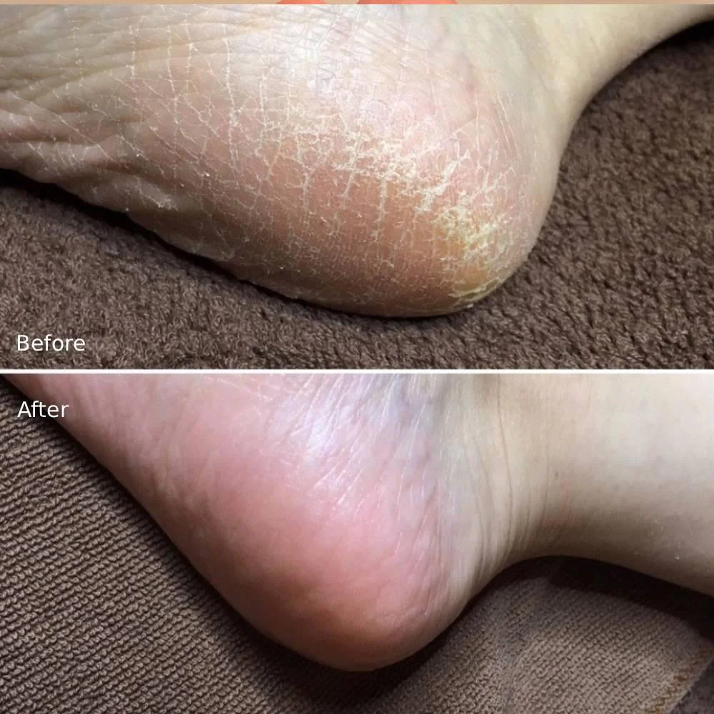 Liberta Baby Foot Exfoliation Foot Peal for Men 60 Minutes Treatment - Image 5